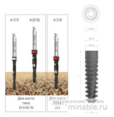 Имплантация зубов имплантаты